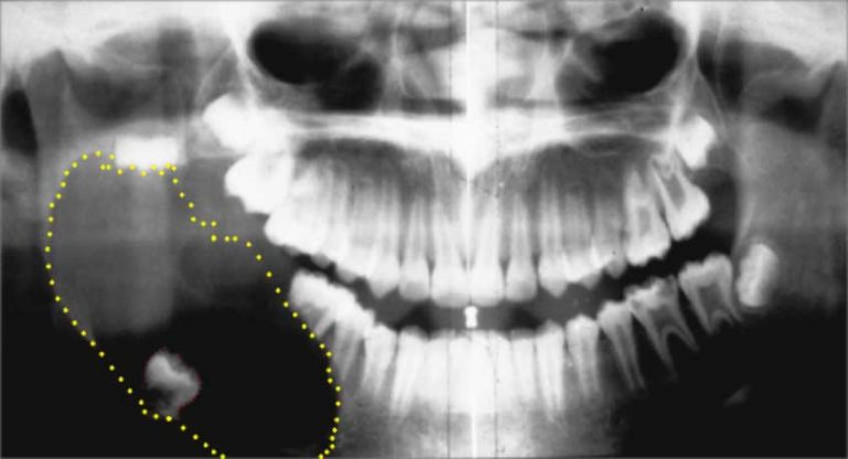 Çene Cerrahisi Operasyonu Sonrası Tavsiyeler Dentram Diş Klinikleri
