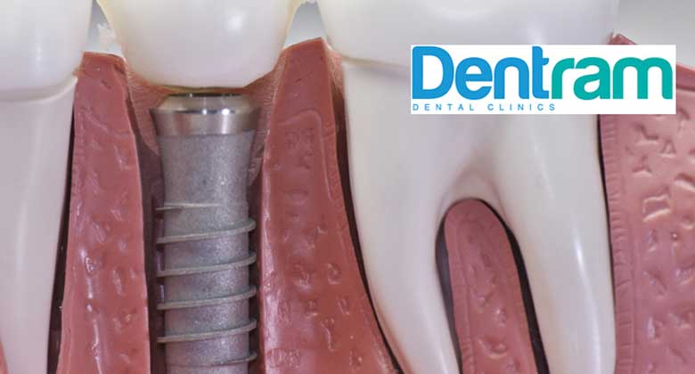 Dental Implants: Types, Pain, Cost - Dentram Dental Clinics