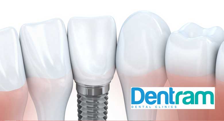 Dental Implant Average Cost - Dentram Dental Clinics