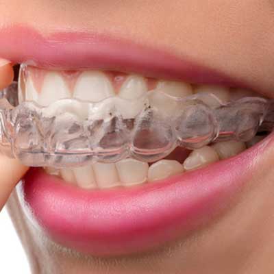 Porcelain Veneers on Teeth - Dentram Dental Clinics